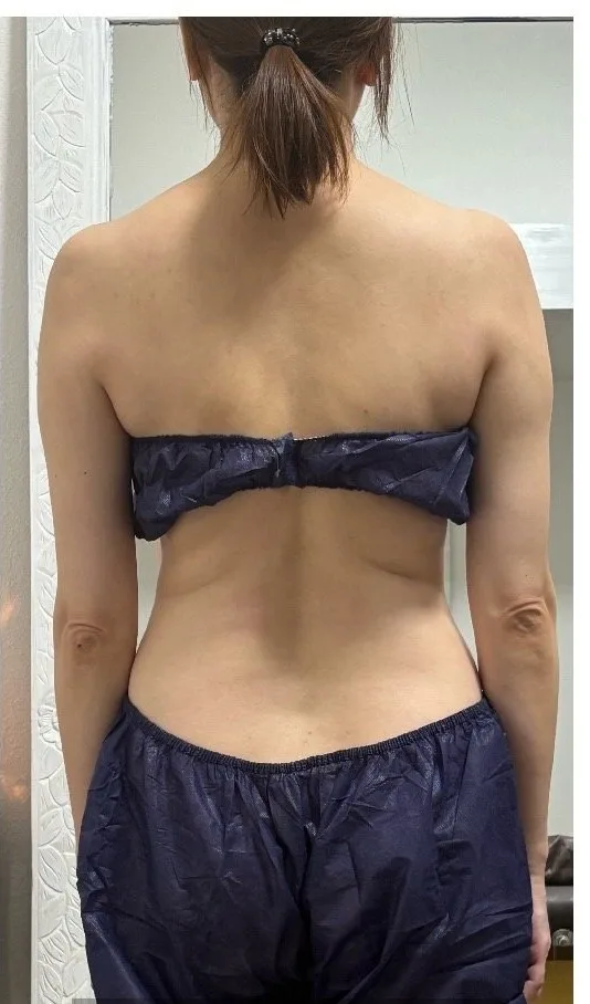 ボディライン ビフォーアフター 施術後